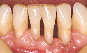 Tænder med synlige rødder pga. parodentose